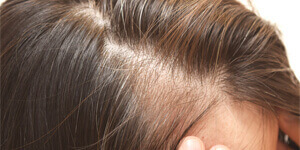 Semnele căderii părului